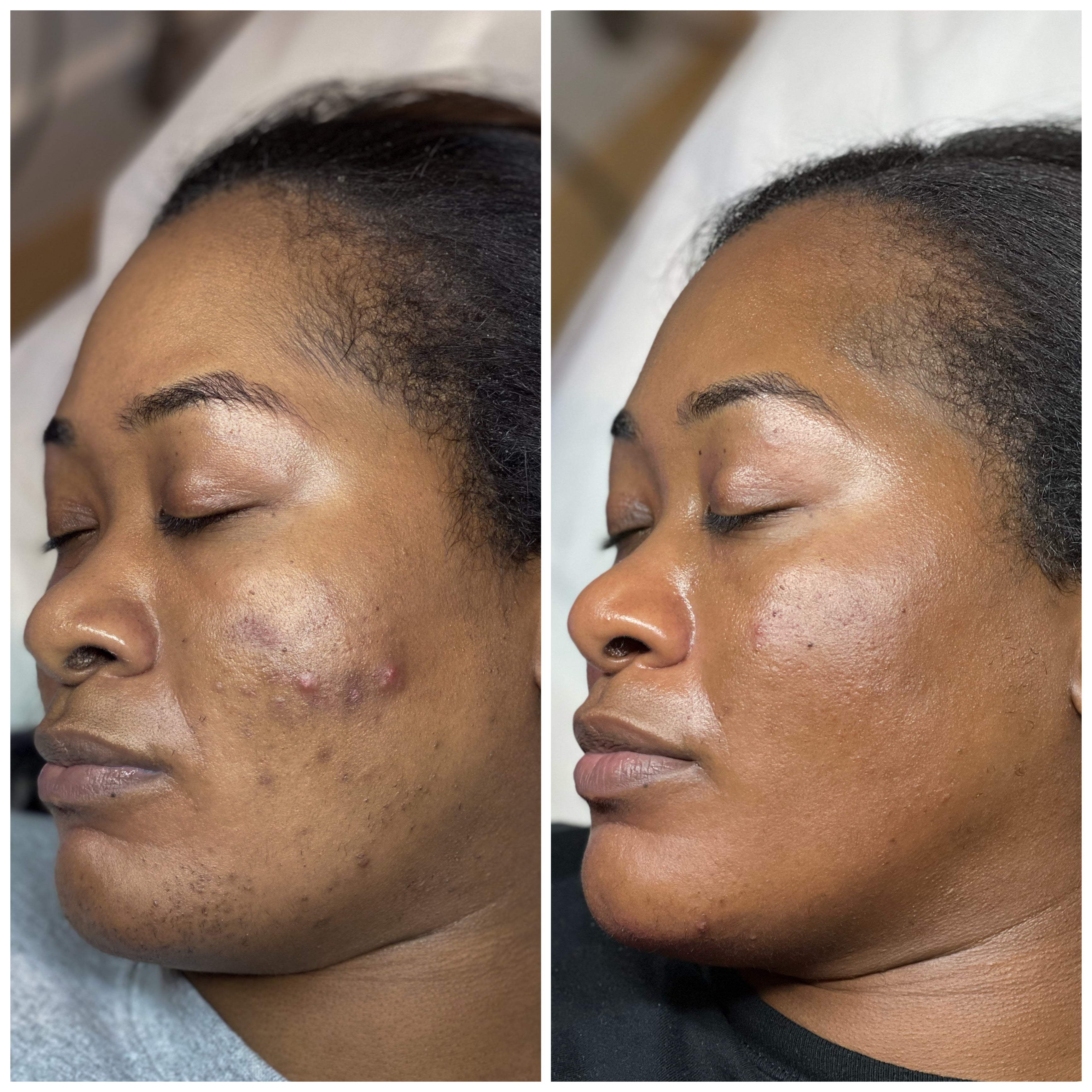 Virtue RF Microneedling in Atlanta | Luminaire Skin + Wellness