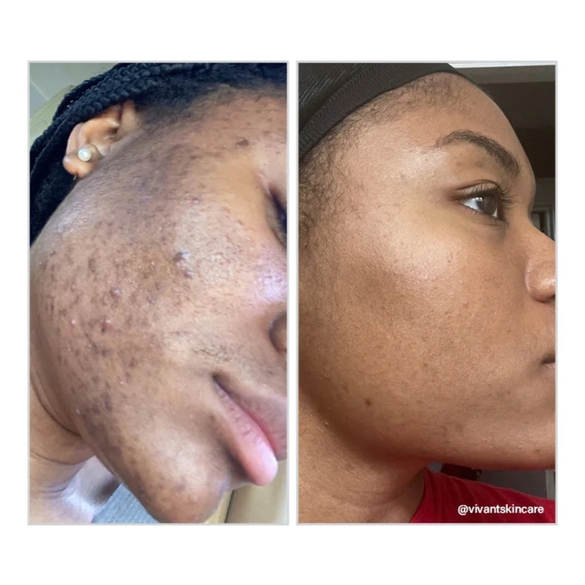 8% Mandelic Acid Serum