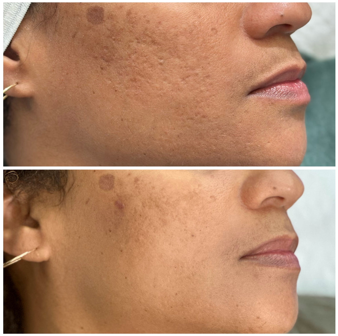 Virtue RF Microneedling in Atlanta | Luminaire Skin + Wellness